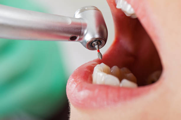 Best Emergency Dentist for Lost Fillings or Crowns in Escobares, TX